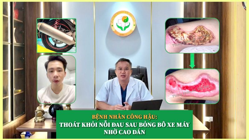 Chữa bỏng bô xe máy tại nhà: Bệnh nhân Công Hậu thoát nỗi đau nhờ Cao dán Chữa bỏng bô xe máy tại nhà: Bệnh nhân Công Hậu thoát nỗi đau nhờ Cao dán
