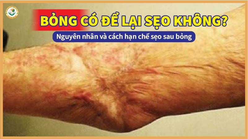Bỏng có để lại sẹo không? Nguyên nhân và cách hạn chế sẹo sau bỏng