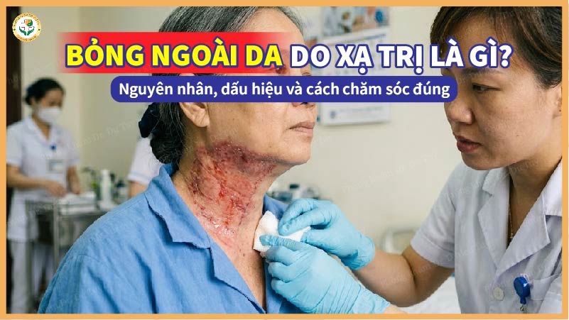 bỏng da sau xạ trị là gì?