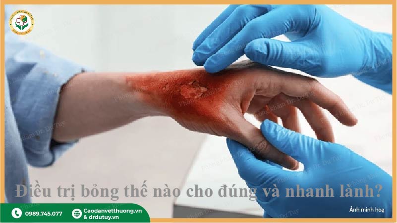 bỏng dầu ăn bôi gì