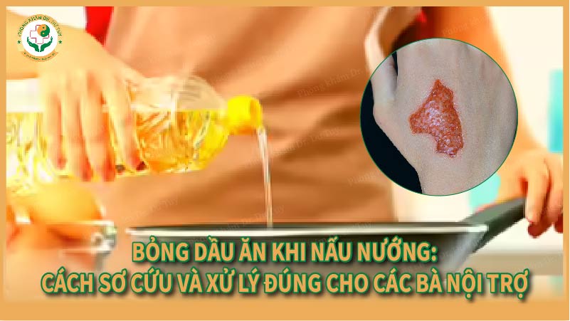 Bỏng dầu ăn khi nấu nướng: Cách sơ cứu và xử lý đúng cho các bà nội trợ