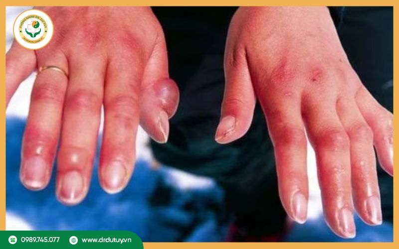 Bỏng lạnh là gì? Sơ cứu đúng cách khi bị bỏng lạnh