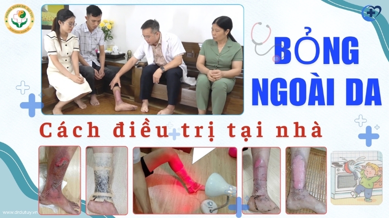 bỏng ngoài da cách điều trị tại nhà
