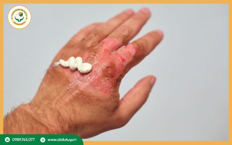 Bỏng nước sôi bôi gì nhanh khỏi? 