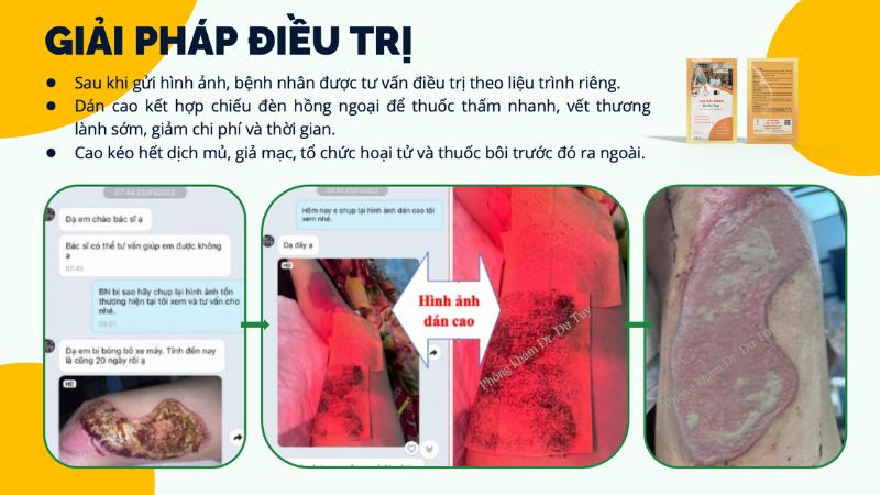 bỏng xe máy độ 3, 4