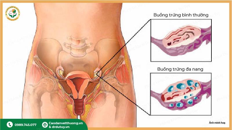 buồng trứng bình thường và buồng trứng đa nang