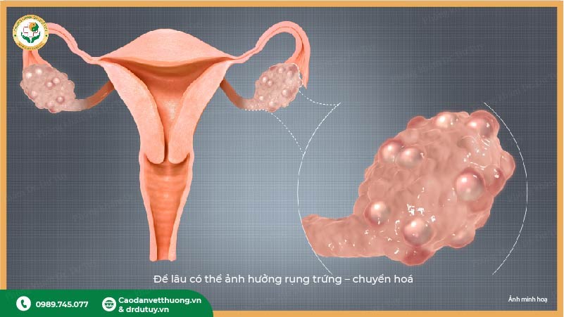 buồng trứng đa nang ảnh hưởng rụng trứng