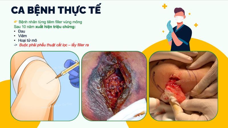 ca bệnh thực tế biến chứng filler vùng mông
