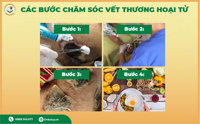 các bước chăm sóc vết thương hoại tử