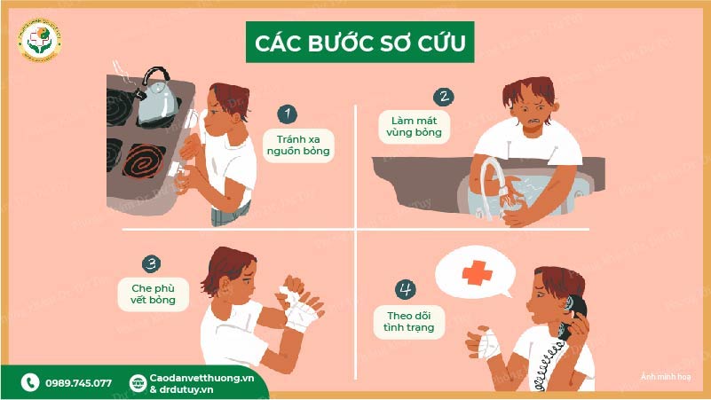 các bước sơ cứu bỏng