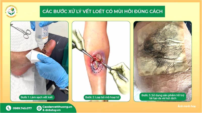 các bước xử lý vết loét có mùi hôi đúng cách