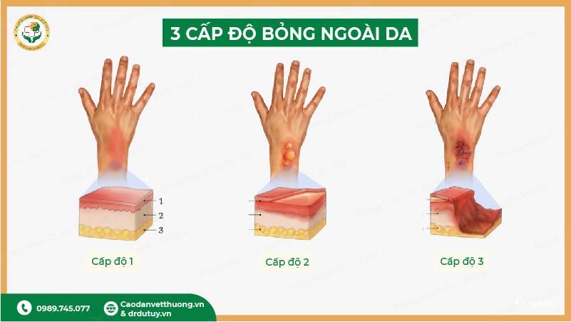các cấp độ bỏng ngoài da 1, 2, 3