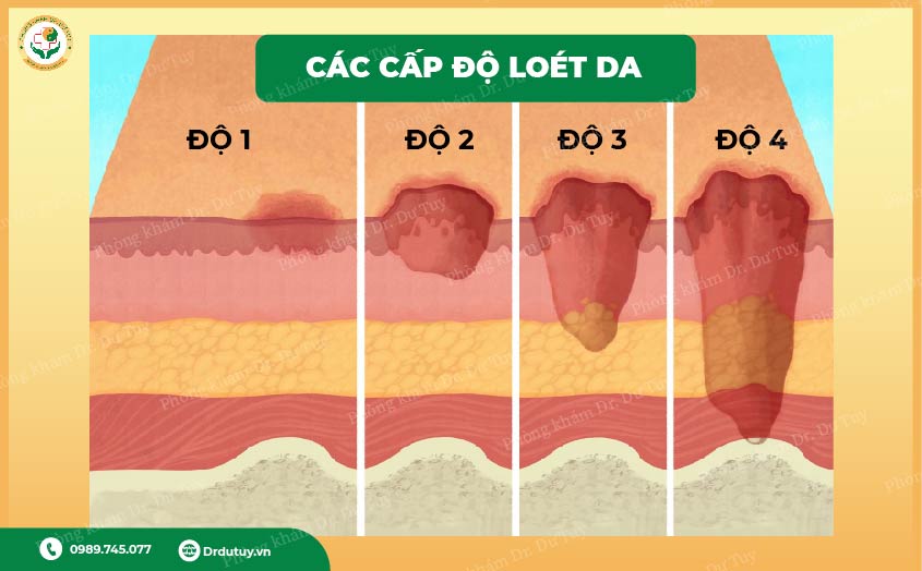 các cấp độ loét da