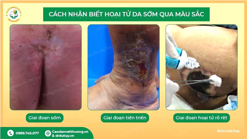 các giai đoạn hoại tử da qua màu sắc