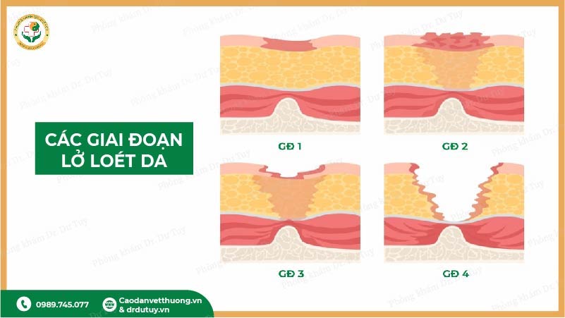 các giai đoạn lở loét da