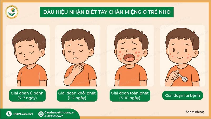 các giai đoạn phát triển bệnh tay chân miệng ở trẻ