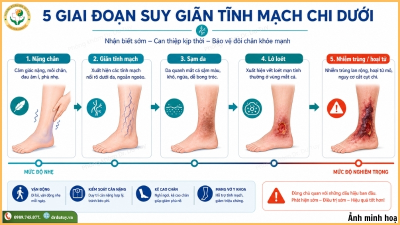 các giai đoạn suy giãn tĩnh mạch chi dưới