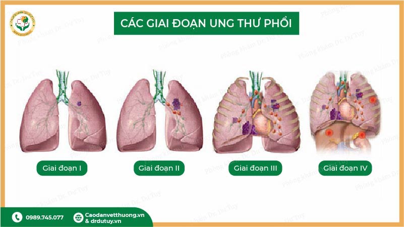các giai đoạn ung thư phổi từ giai đoạn 1 đến 4