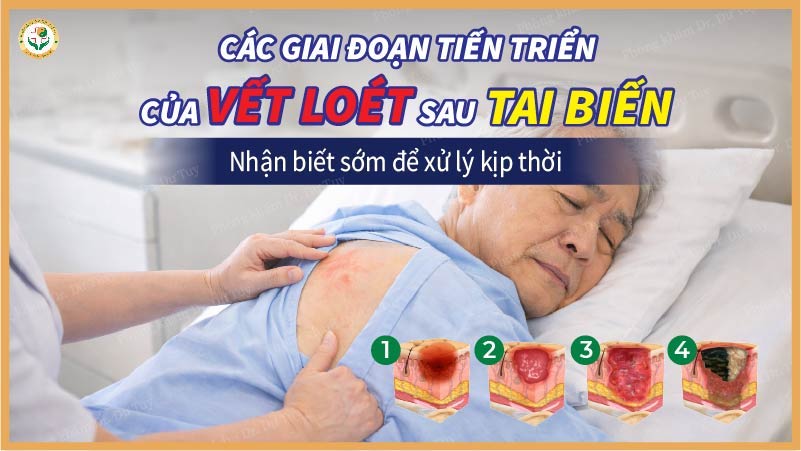 Các giai đoạn tiến triển của vết loét sau tai biến – Nhận biết sớm để xử lý kịp thời