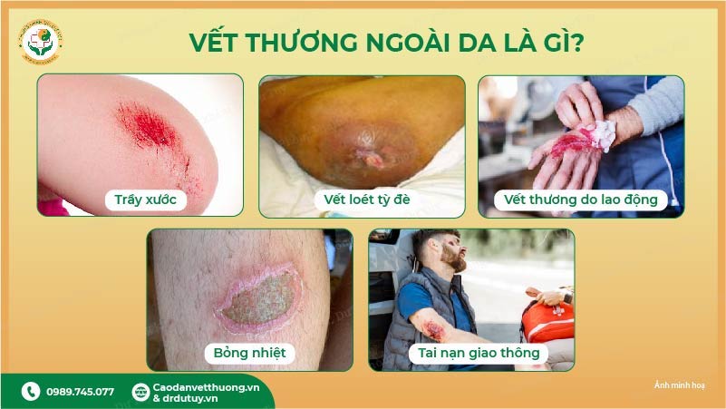 các loại vết thương ngoài da phổ biến