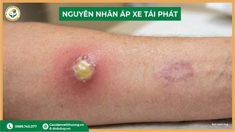 các nguyên nhân áp xe tái phát