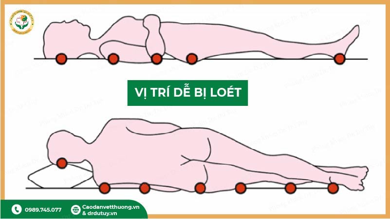 các vị trí dễ bị loét tì đè trên cơ thể