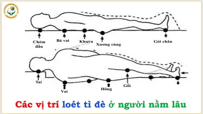 các vị trí loét tì đè ở người nằm lâu