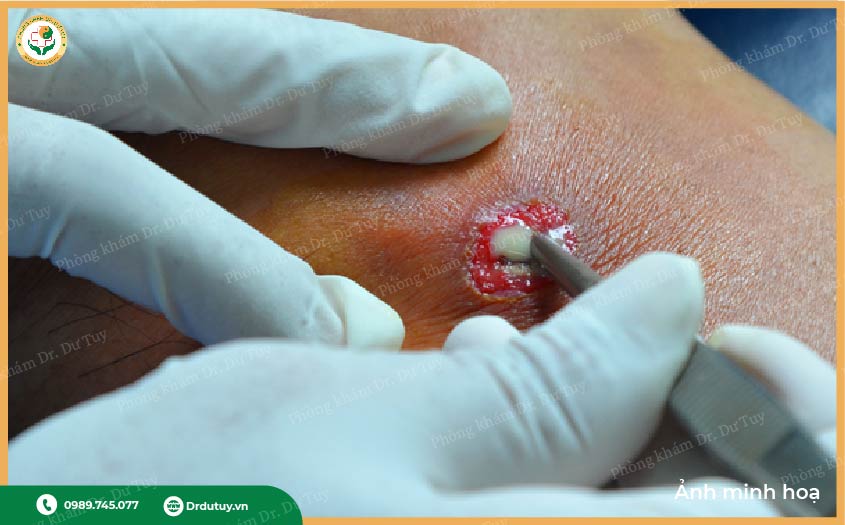 cách chữa áp xe