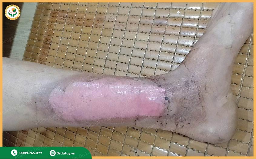 cách chữa bỏng hiệu quả