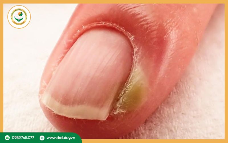 Cách chữa chín mé tại nhà bằng phương pháp dân gian 