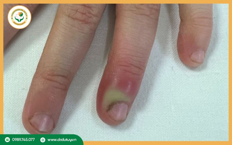 Triệu chứng của bệnh chín mé