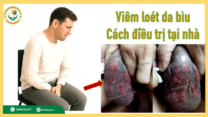 Cách chữa viêm da bìu tại nhà