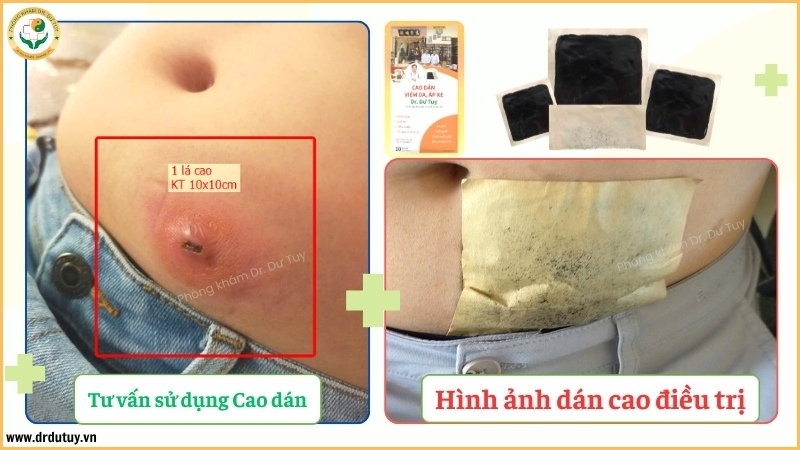 cách dán cao 10x 10cm cho ổ áp xe