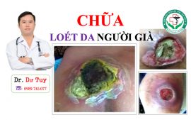 Cách điều trị loét da cho người già