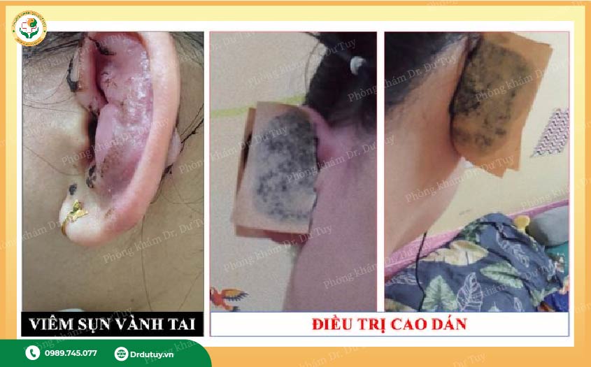 cách điều trị viêm sụn vành tai