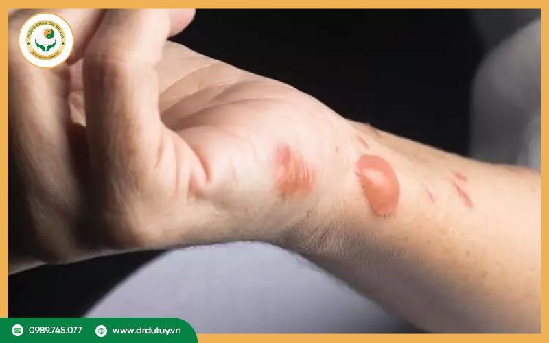 Cách làm giảm đau rát khi bị bỏng hiệu quả tại nhà