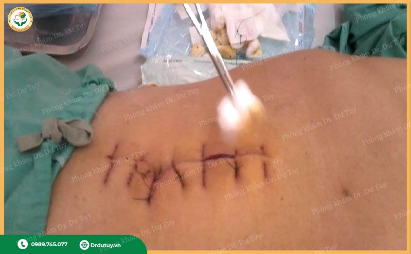 cách làm khô mủ nhanh