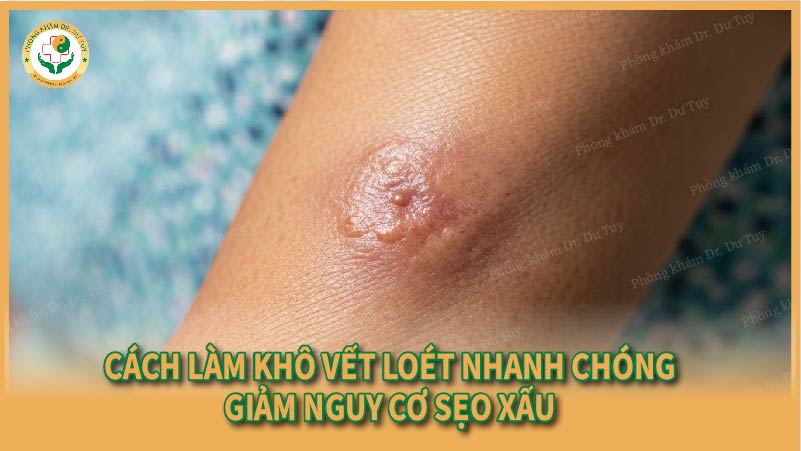 Cách làm khô vết loét nhanh chóng – Giảm nguy cơ sẹo xấu
