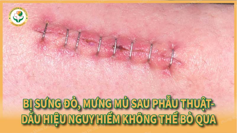 Bị sưng đỏ, mưng mủ sau phẫu thuật- Dấu hiệu nguy hiểm không thể bỏ qua