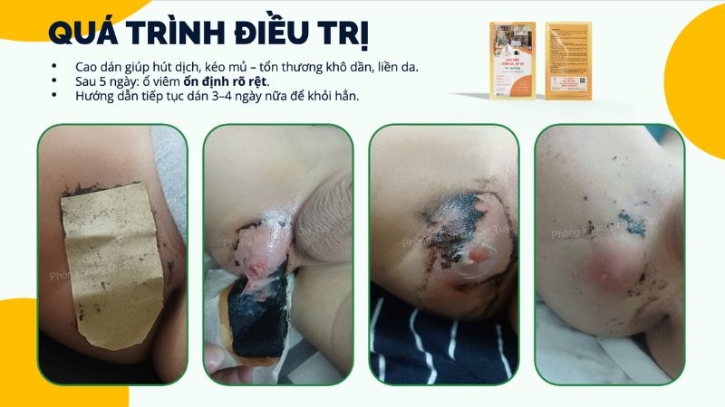 cách trị áp xe cho bé