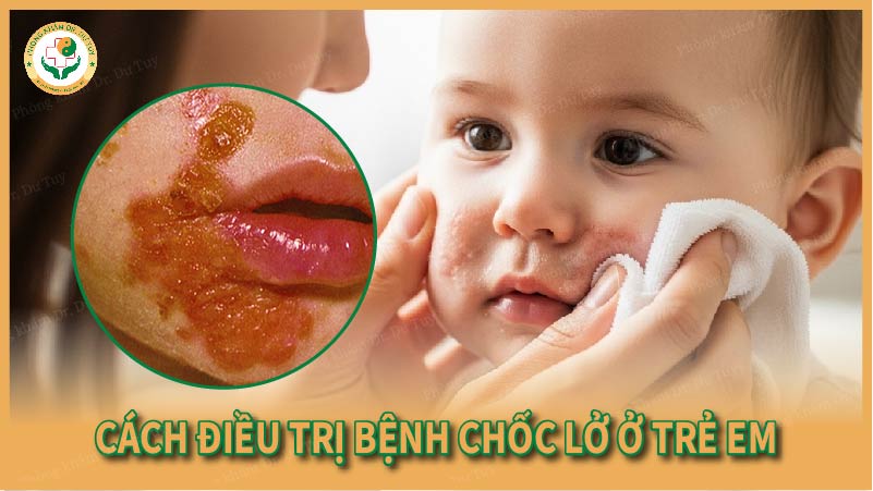Cách điều trị bệnh chốc lở ở trẻ em