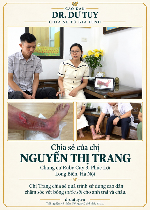 Phục hồi da sau bỏng nước sôi