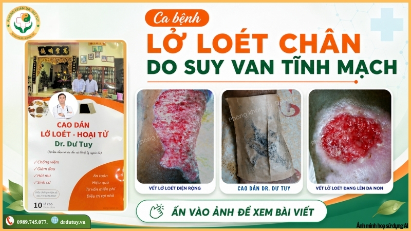 cách trị loét chân do suy van tĩnh mạch