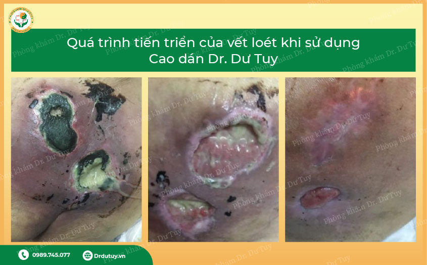 cách trị loét da