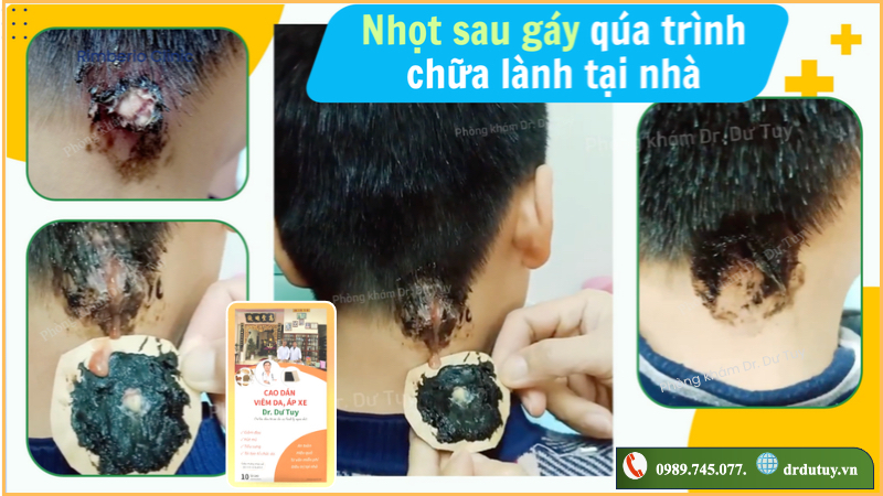 cách trị mụn nhọt tại nhà
