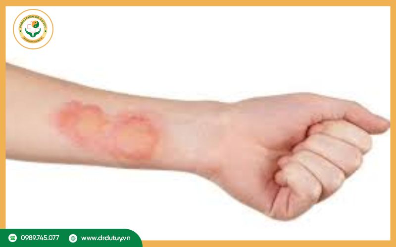Nhiễm trùng da là gì?