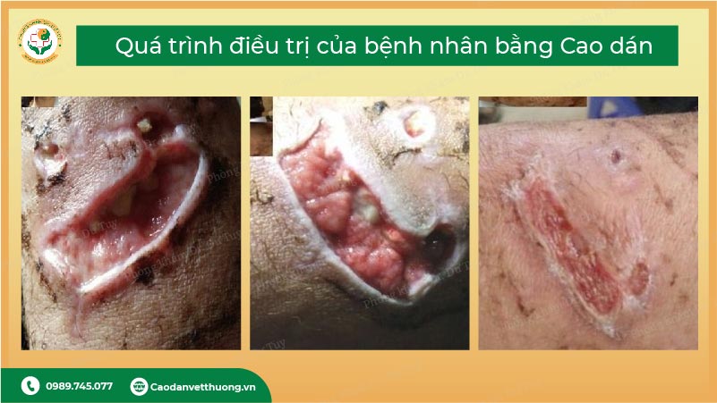 cách trị vết thương do chó cắn