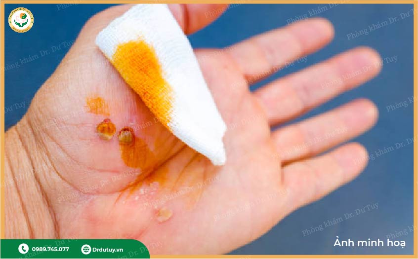 cách trị vết thương mưng mủ tại nhà