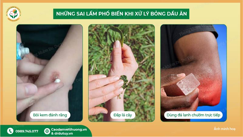 cách xử lý bỏng dầu ăn