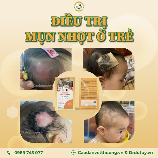 Cách xử lý mụn nhọt không cần chích rạch